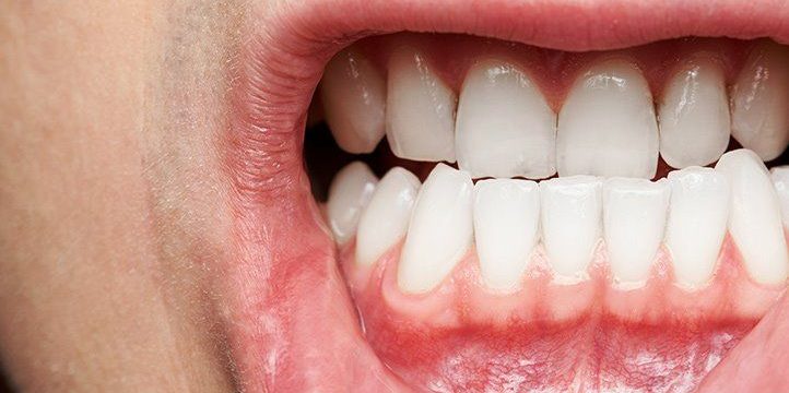 5 Cara Mengembalikan Kesehatan Gusi Setelah Infeksi
