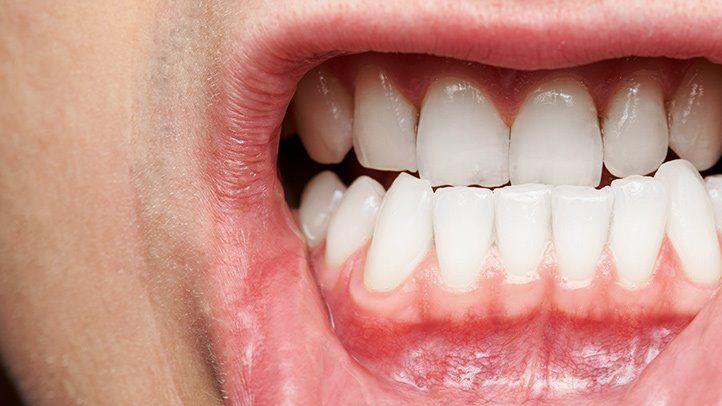 5 Cara Mengembalikan Kesehatan Gusi Setelah Infeksi